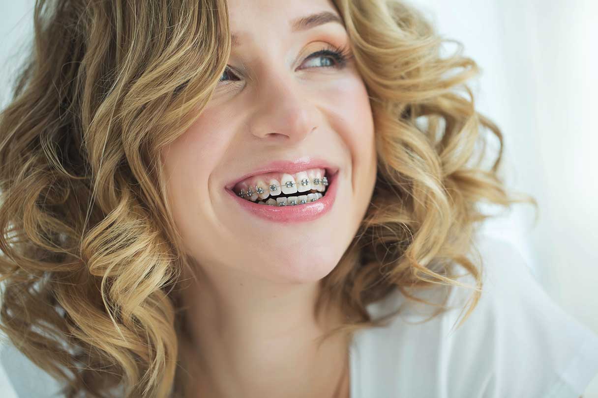 Important Things to Know Before You Get Dental Braces