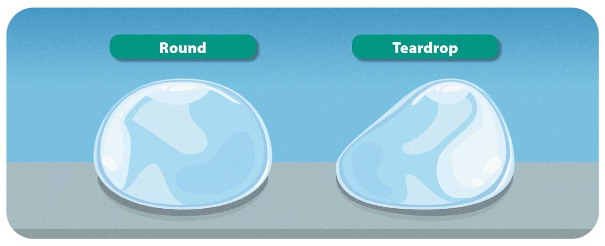 Round vs. Teardrop implants