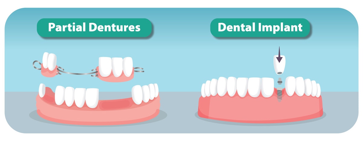 Dental bridge vs implant