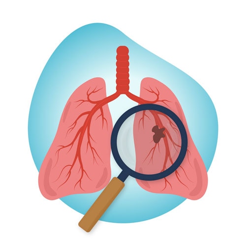 Lung cancer screening